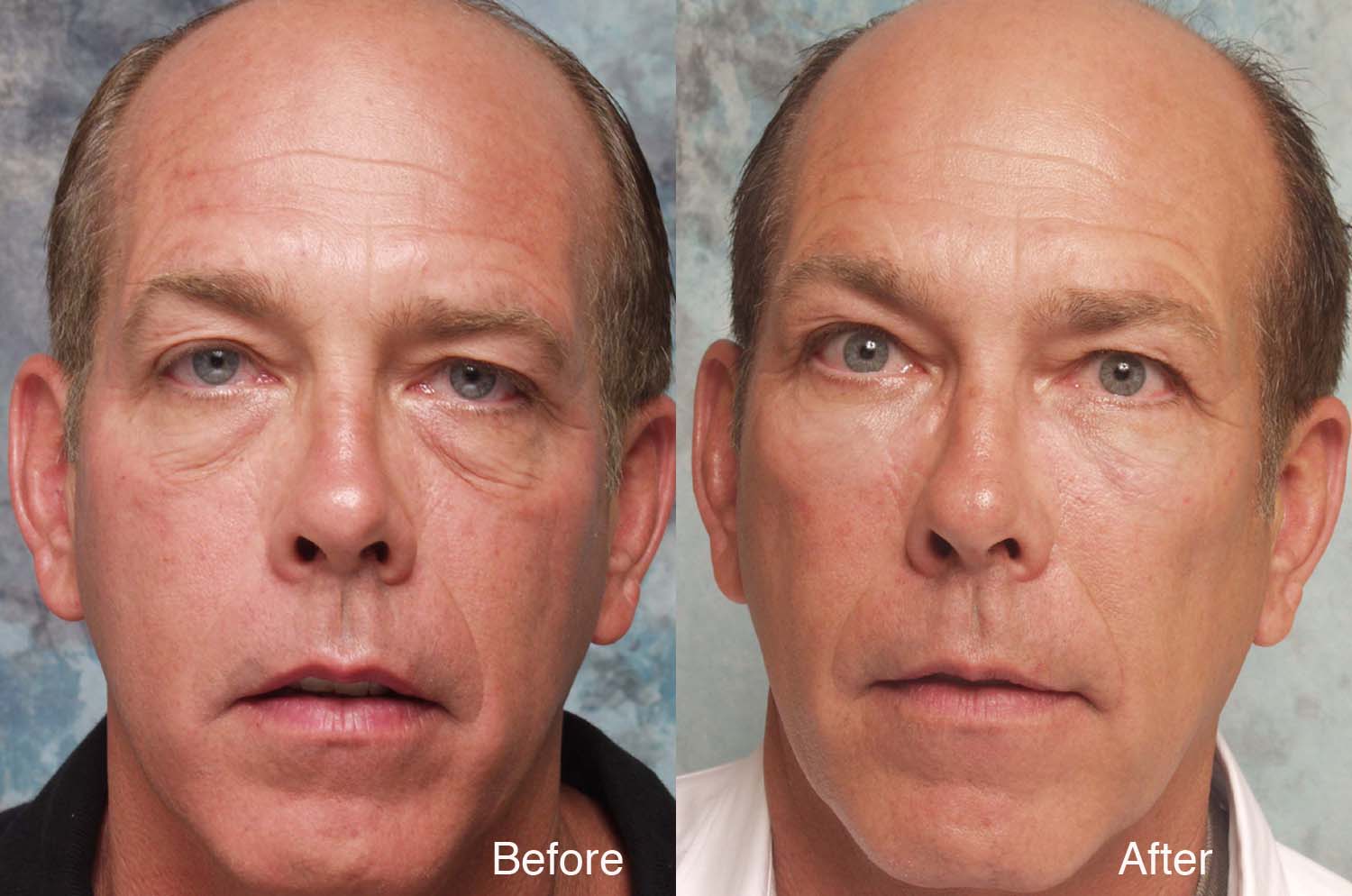 Procedure: Midface Surgery