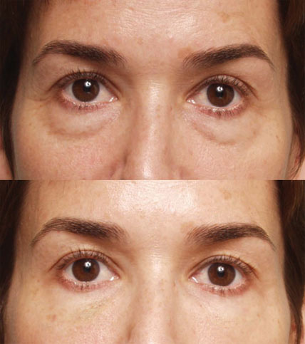 Procedure: Under Eye Case 1