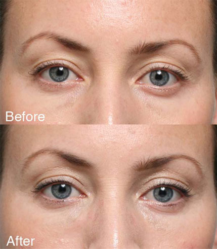 Procedure: Under Eye Case 3
