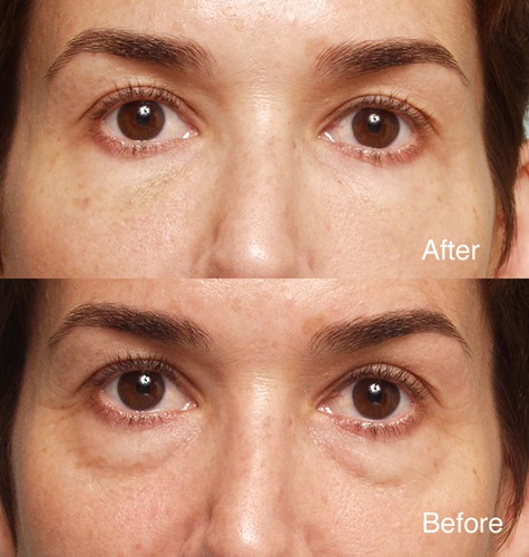Procedure: Undereye Deepfill™ Restylane® and Microdroplet Lift® BOTOX®