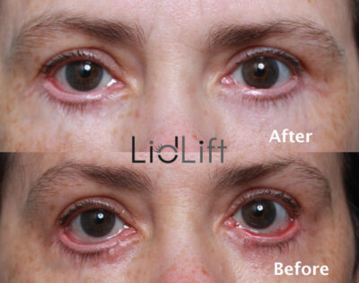 "Lower eyelid retraction before and after revision blepharoplasty performed by Dr. Kenneth Steinsapir."